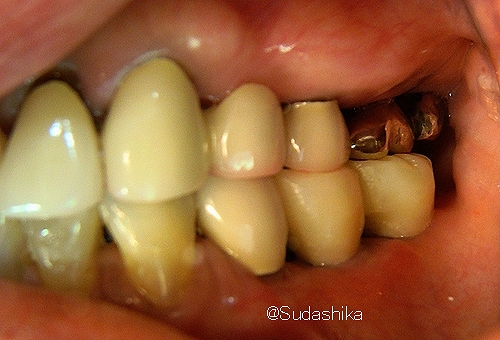 奥歯2本のインプラント＠須田歯科