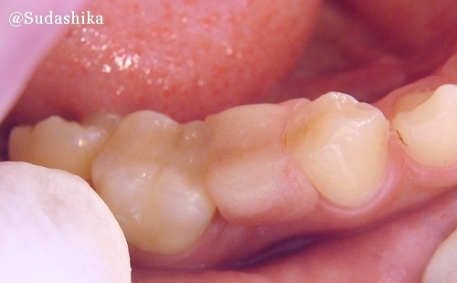 下顎のインプラントの症例（須田歯科）