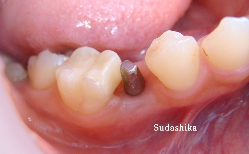 下顎のインプラントの症例（須田歯科）