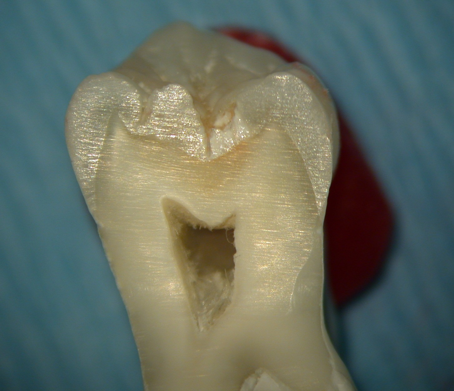 Extracted tooth (1)