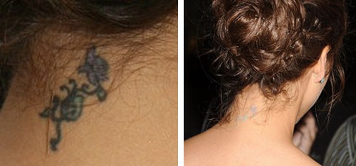 Jessica-Alba-tattoo-removal-3.jpg