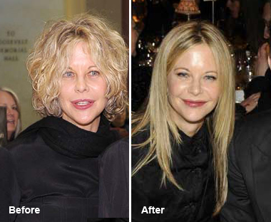 meg-ryan-before-after-plastic-surgery1.jpg