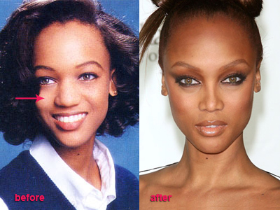 tyra-banks-before-after-plastic-surgery.jpg